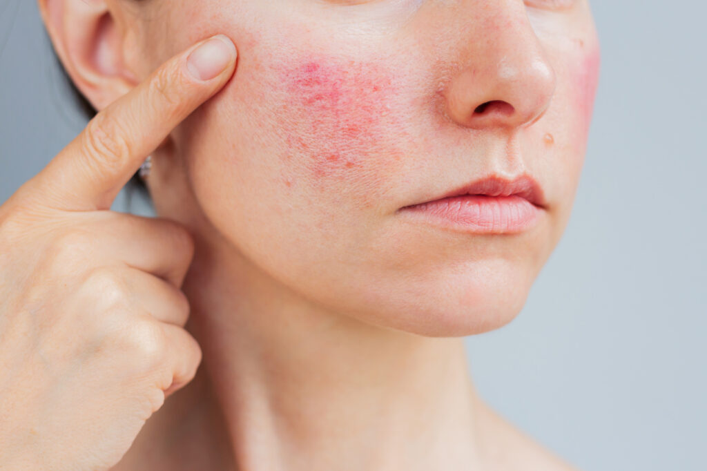 Rosacea durch Histaminintoleranz